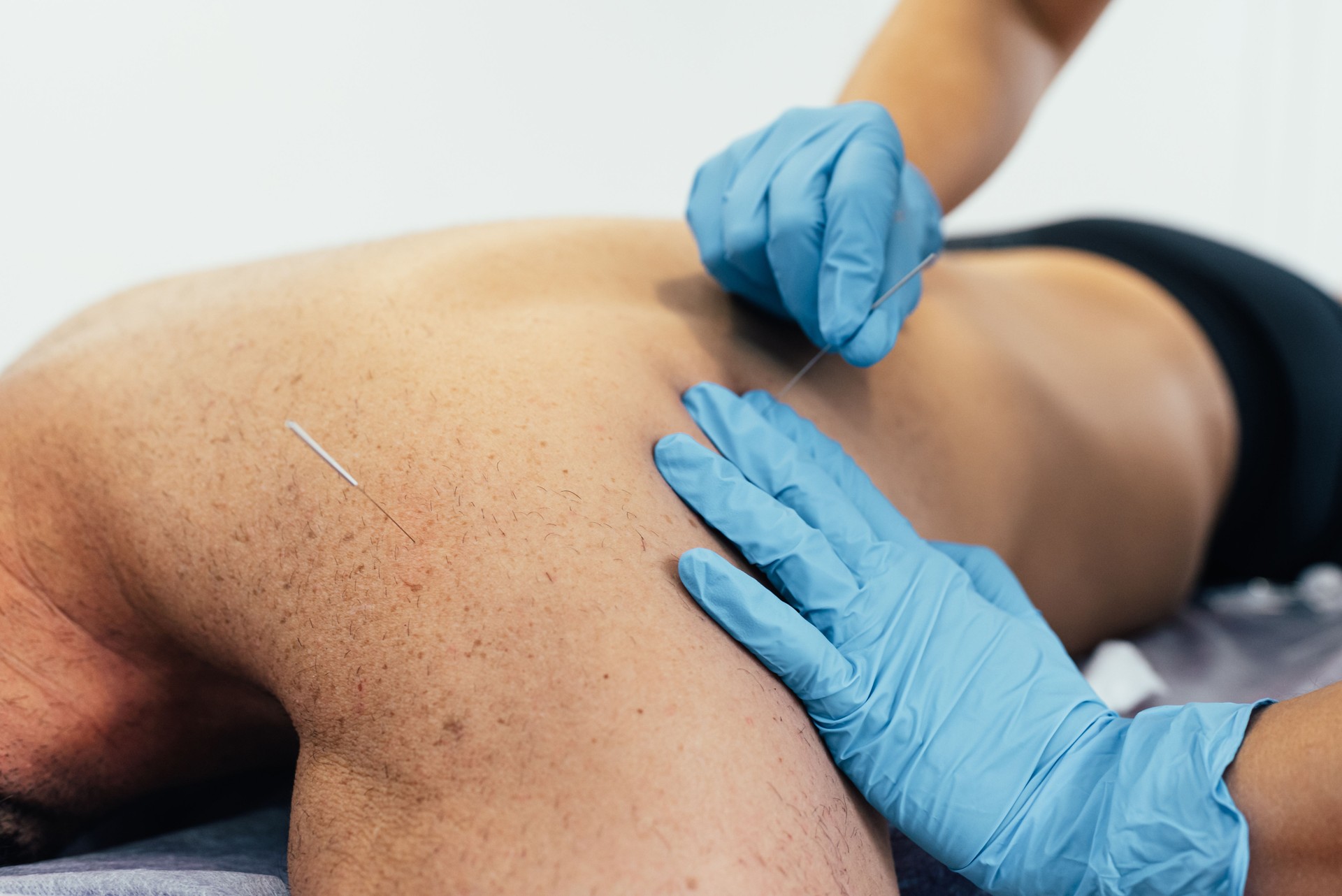 Our physiotherapist performing a dry needling treatment on a patient with back pain.